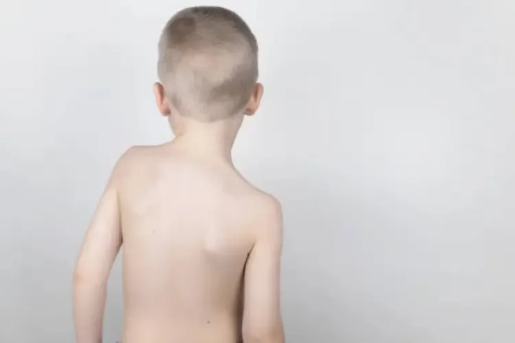 اسکولیوز چیست؟ | چگونه بدون جراحی اسکولیوز را درمان کنیم؟