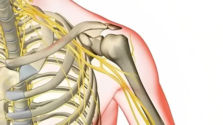 فلج کلامپکه Klumpke palsy چیست؟ | درمان فلج کلامپکه