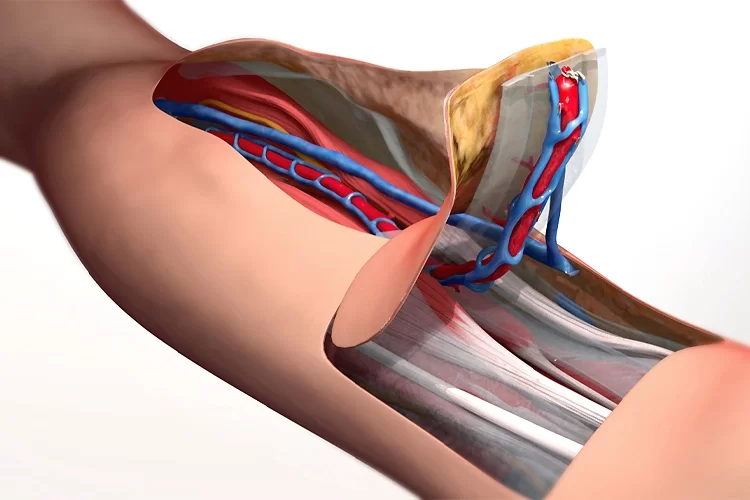 گرافت و فِلَپ پوستی چیست؟ | توانبخشی با عمل جراحی گرافت و فلپ پوستی