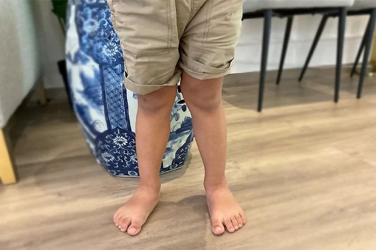 زانوی ضربدری چیست؟ | آیا راستای صحیح پاها در سلامت آینده ما موثر است؟