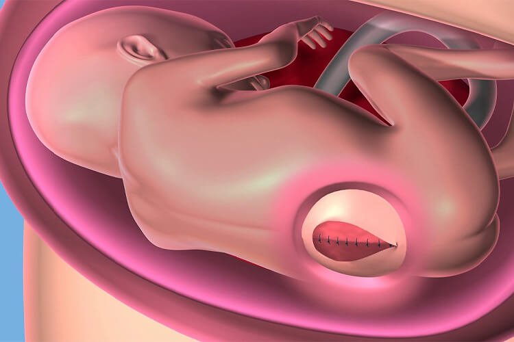 میلومننگوسل چیست؟ | علائم و درمان میلومننگوسل یا شکاف در نخاع