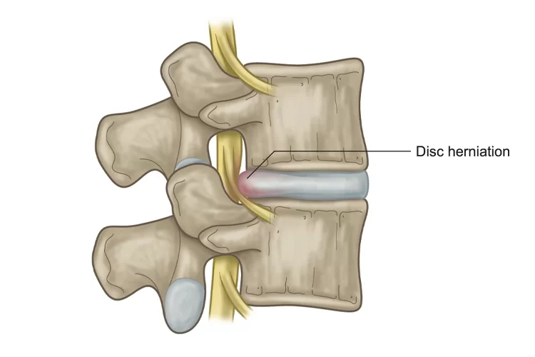 علائم و درمان دیسک کمر | درمان دیسک کمر با روش‌های نوین کاردرمانی