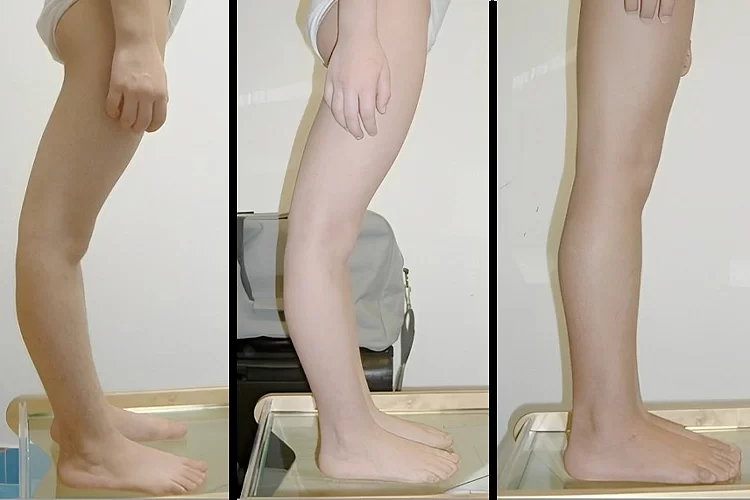 علت عقب زدگی زانو چیست؟ | اصلاح و درمان قطعی عقب زدگی زانو با کاردرمانی