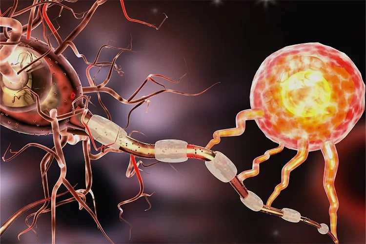 انواع بیماری ام اس (MS) | کامل‌ترین طبقه‌بندی بیماری ام اس