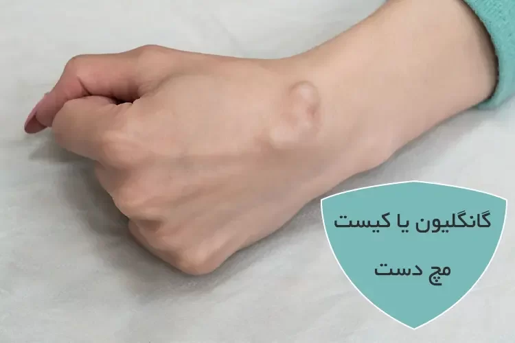گانگلیون یا کیست مچ دست چیست؟ | توانبخشی گانگلیون مچ با کاردرمانی