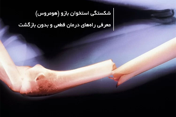 شکستگی استخوان بازو (هومروس) | معرفی راه‌های درمان قطعی و بدون بازگشت