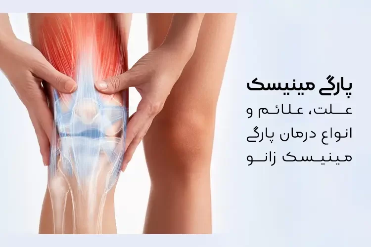 پارگی مینیسک | علت، علائم و انواع درمان پارگی مینیسک زانو