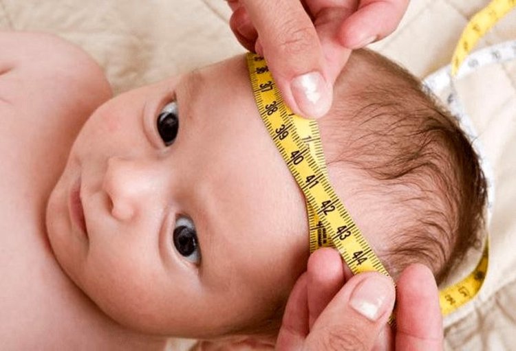 هیدروسفالی